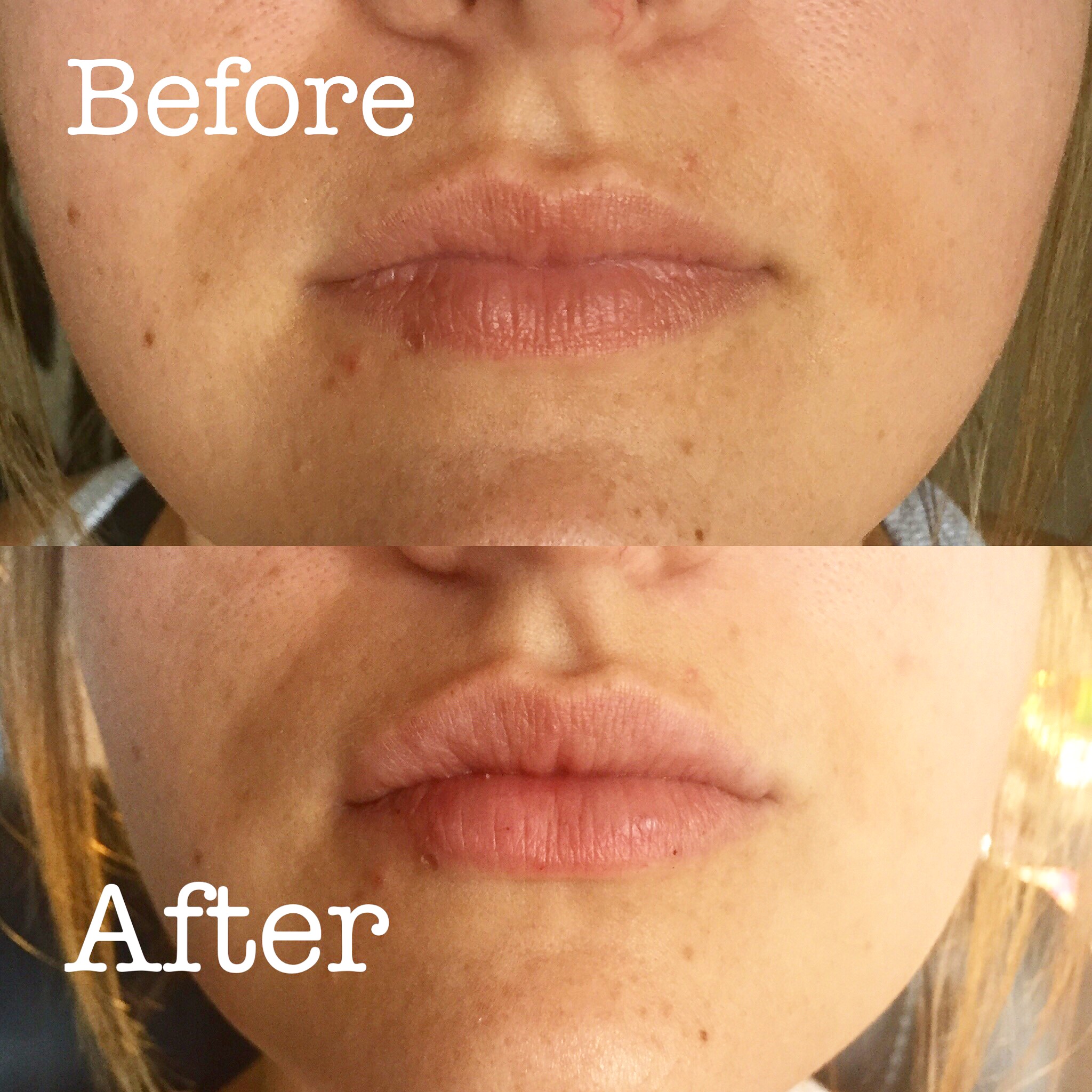 Lip Injections by Nurse Lauren!