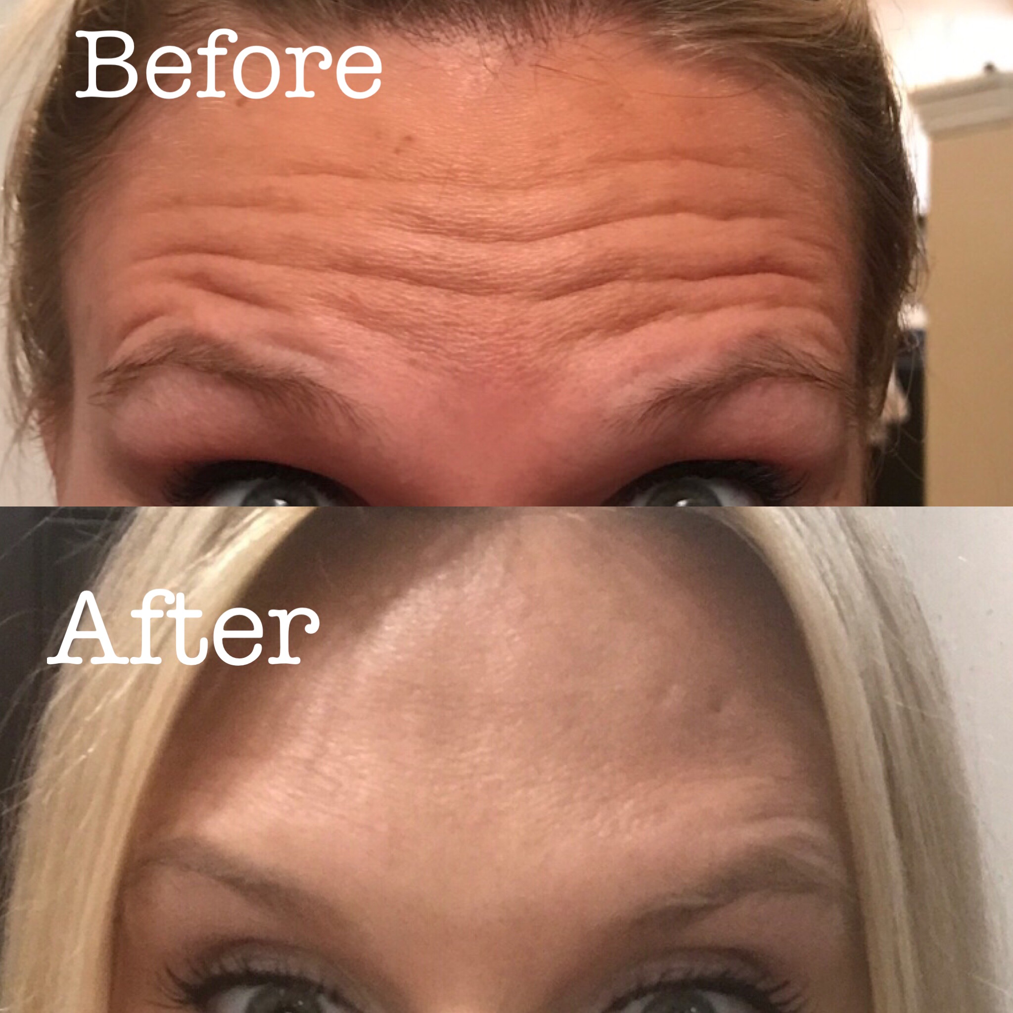Botox Cosmetic