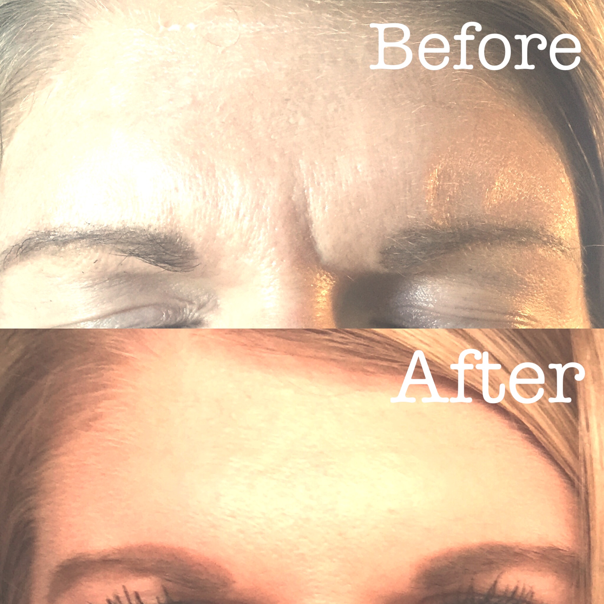 Botox Cosmetic to Frown lines!