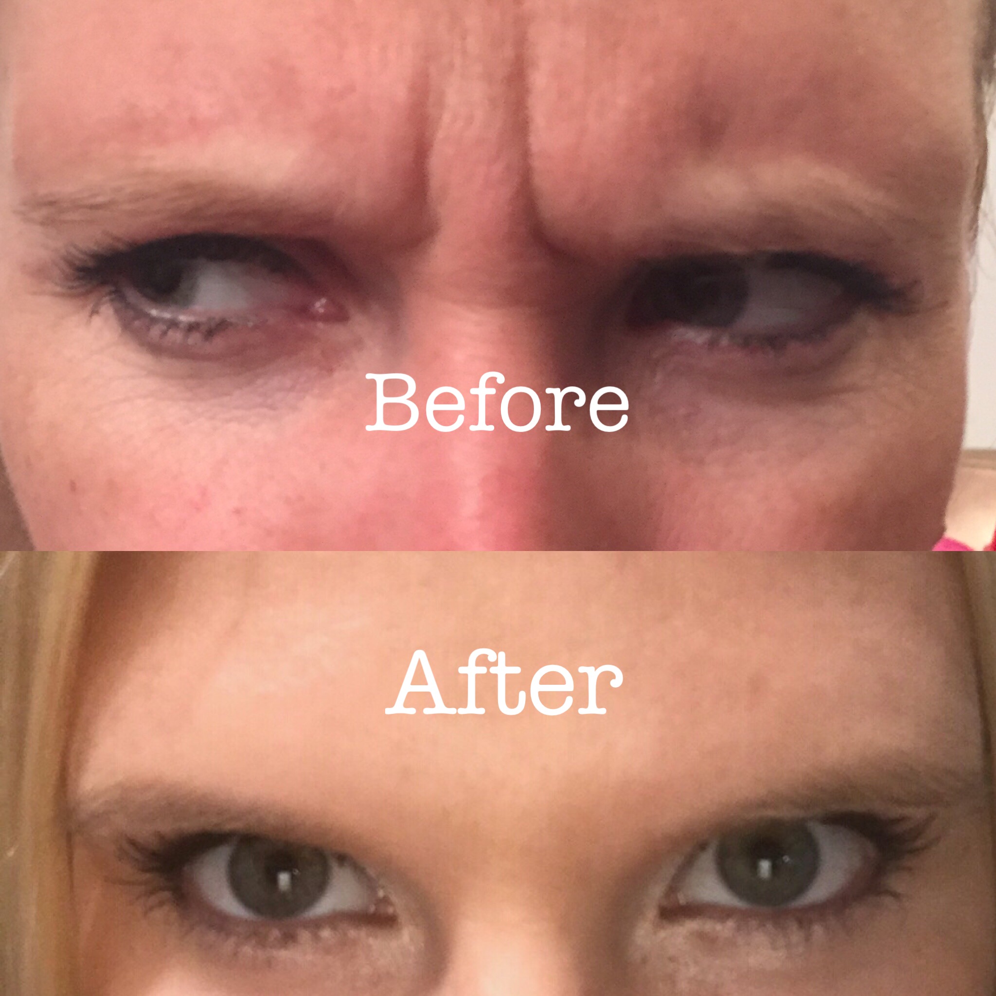 Botox to Glabella area!