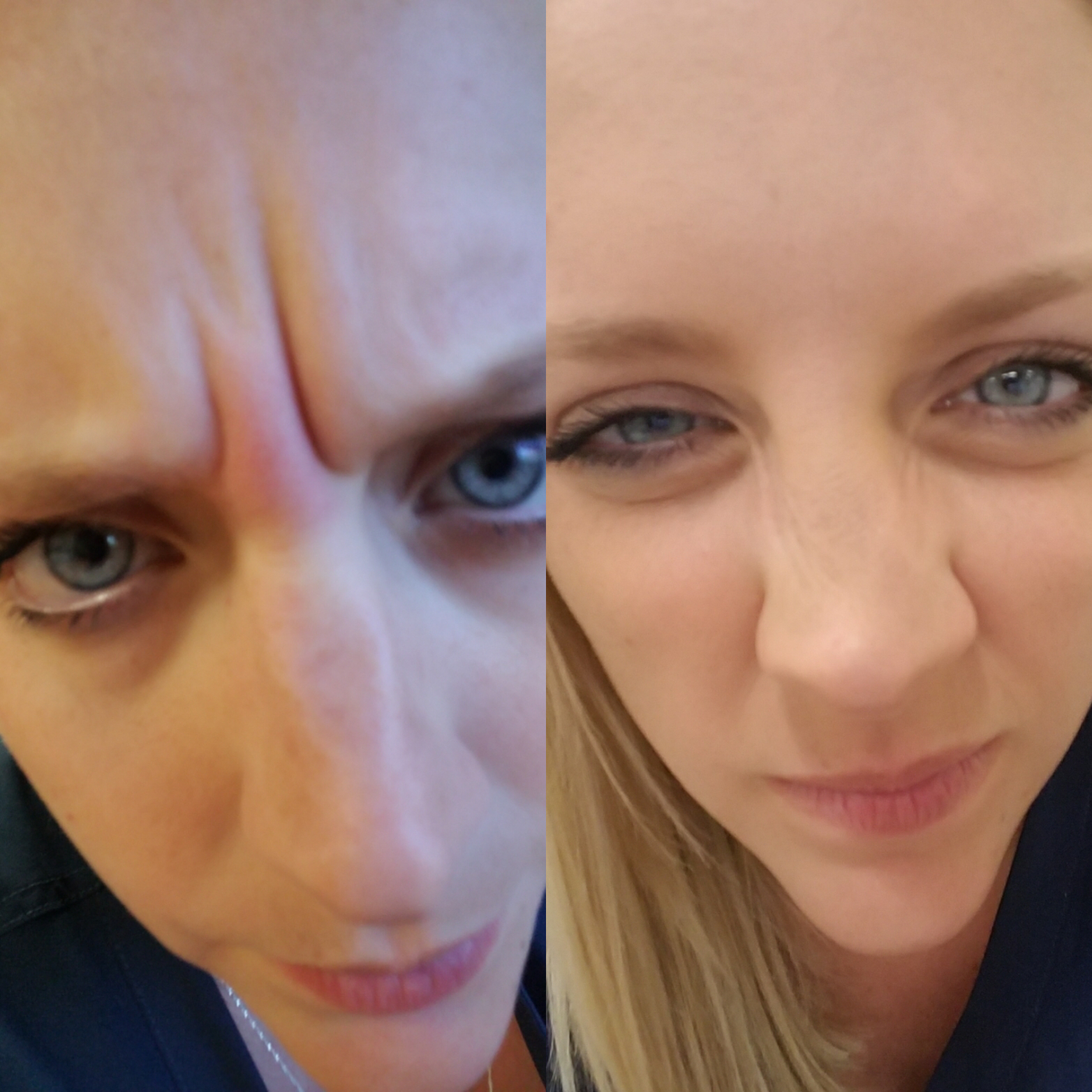 Frown lines gone!