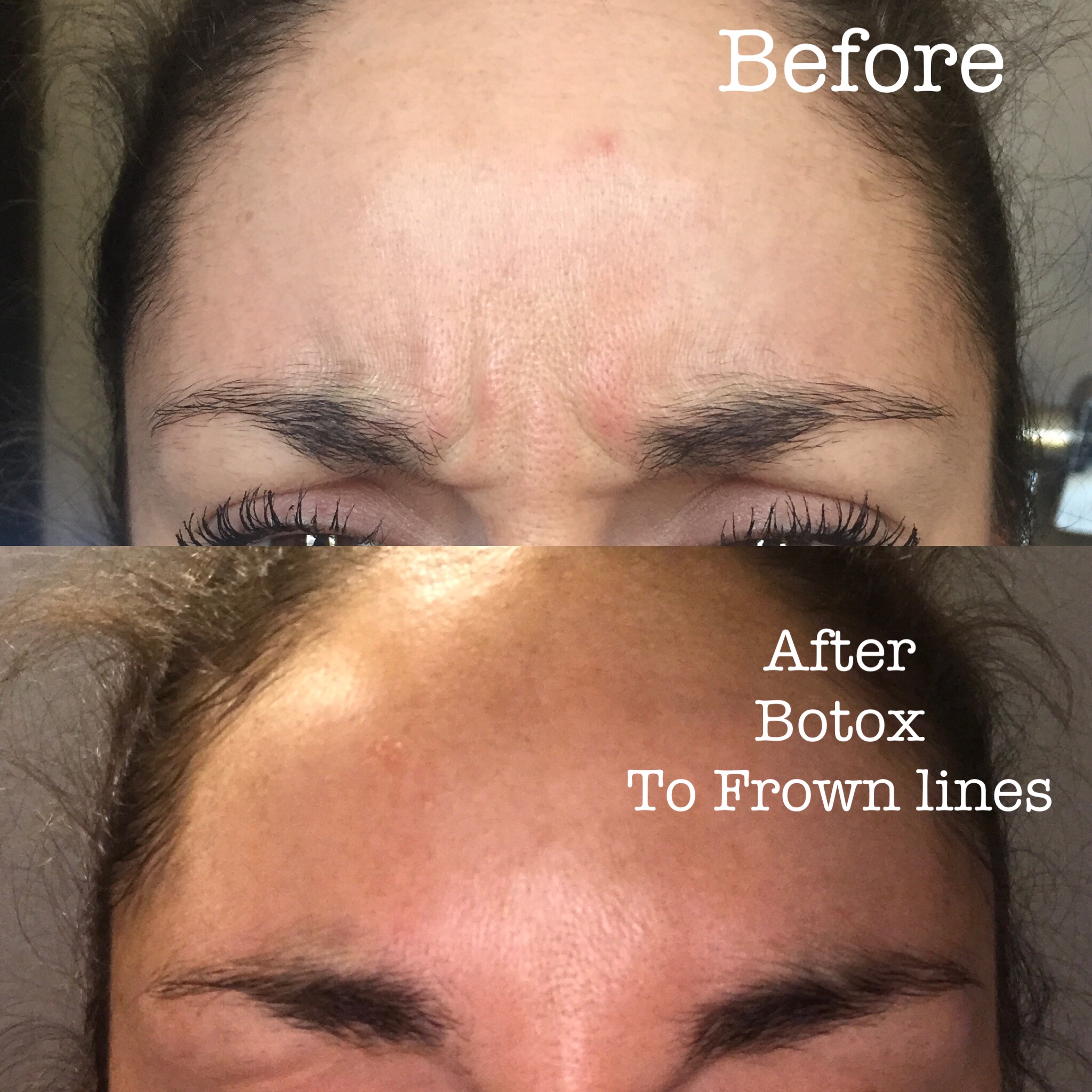 Before and after Botox