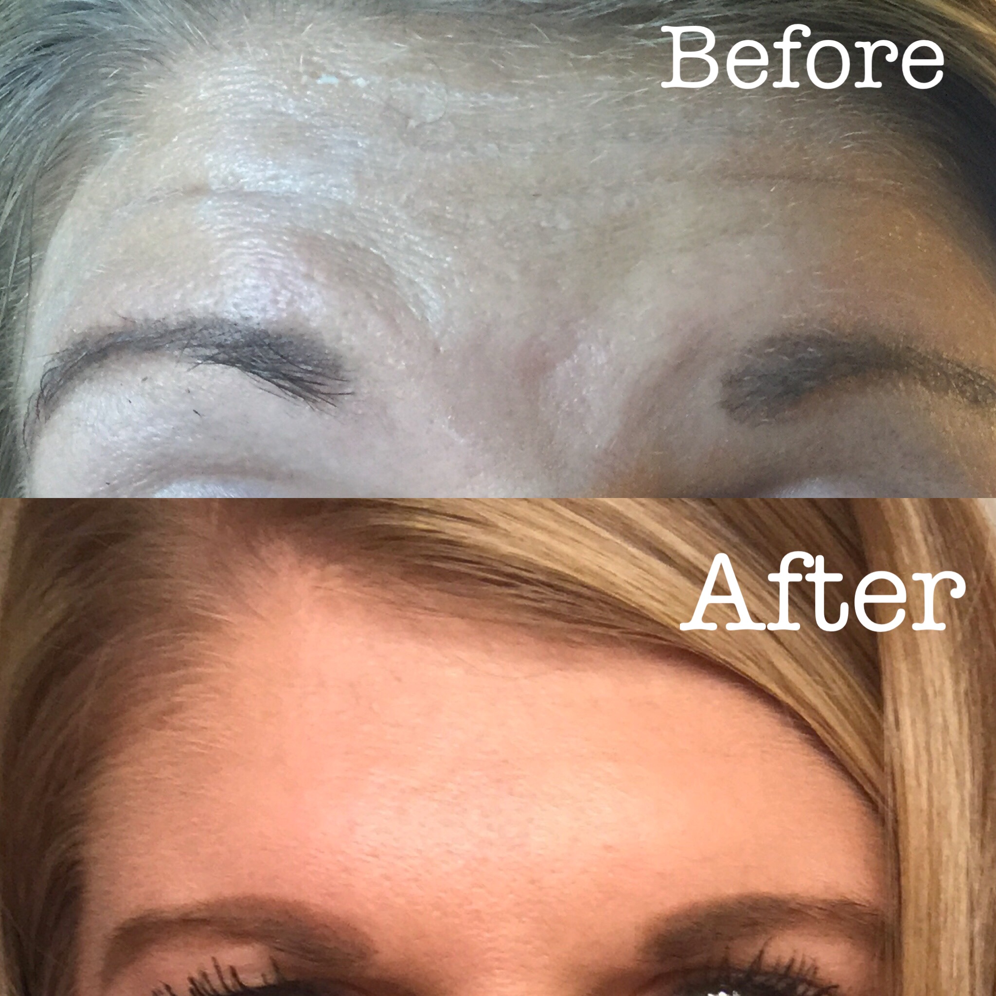 Botox for aging prevention!