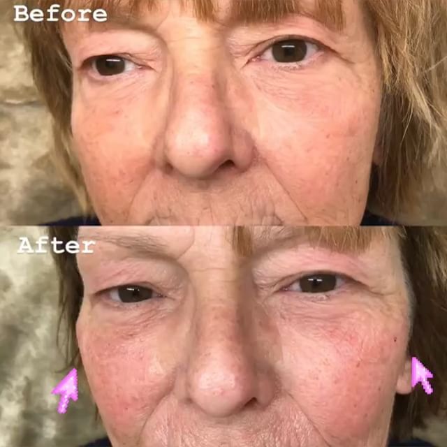 💉Voluma to restore volume to mid face and 💉Vollure for lip augmentation and to smooth wrinkles aro