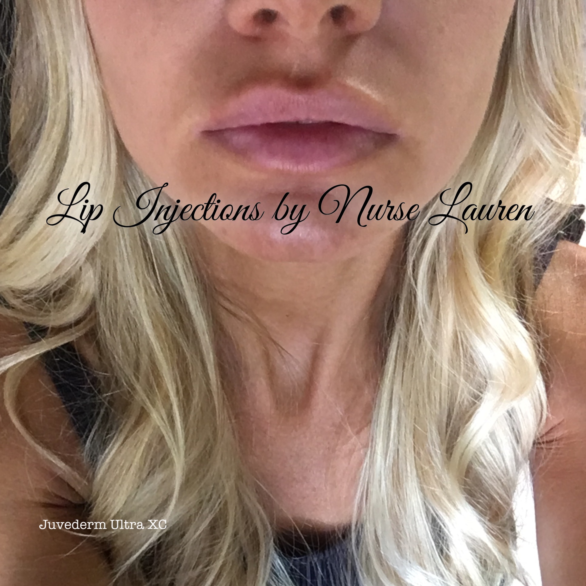 Juvederm Ultra XC! 1 syringe!