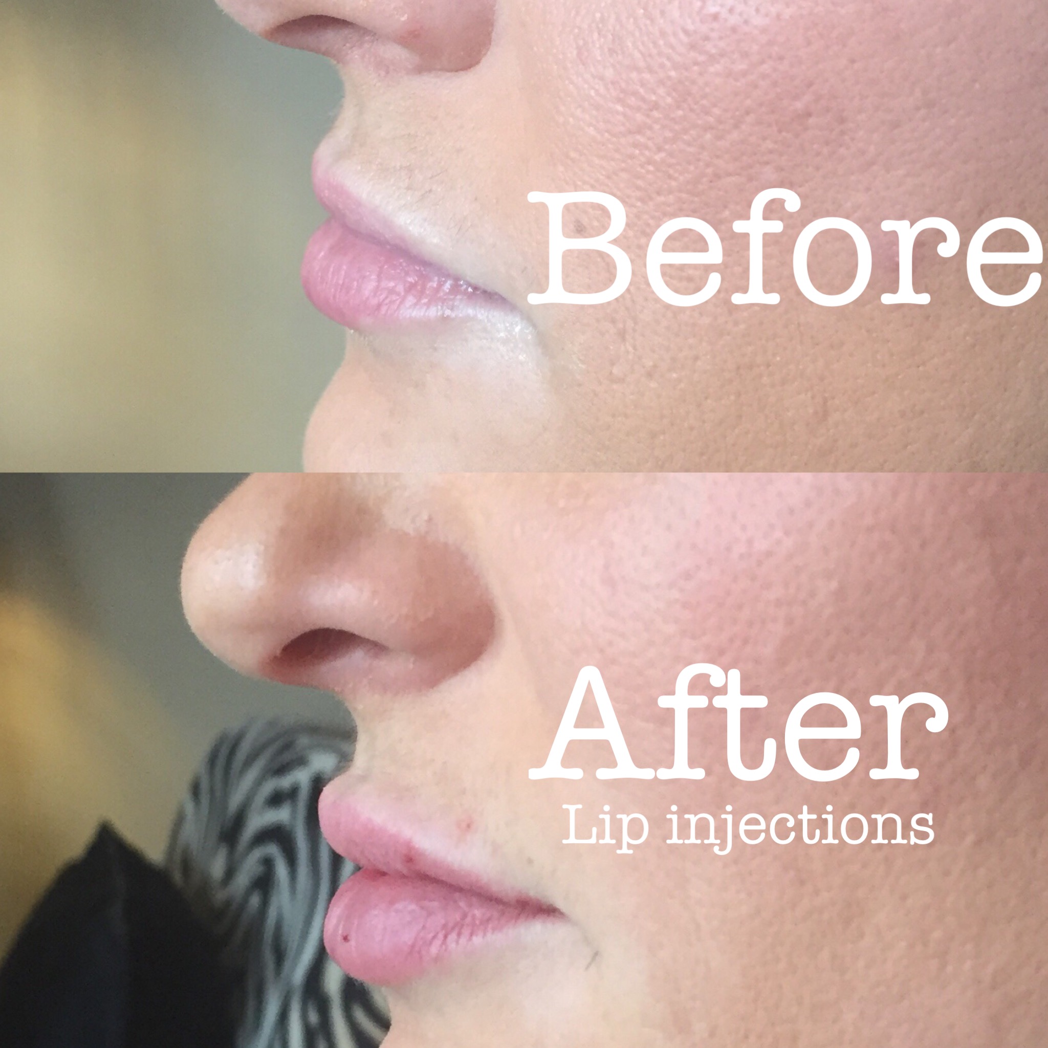 Side view lip injections
