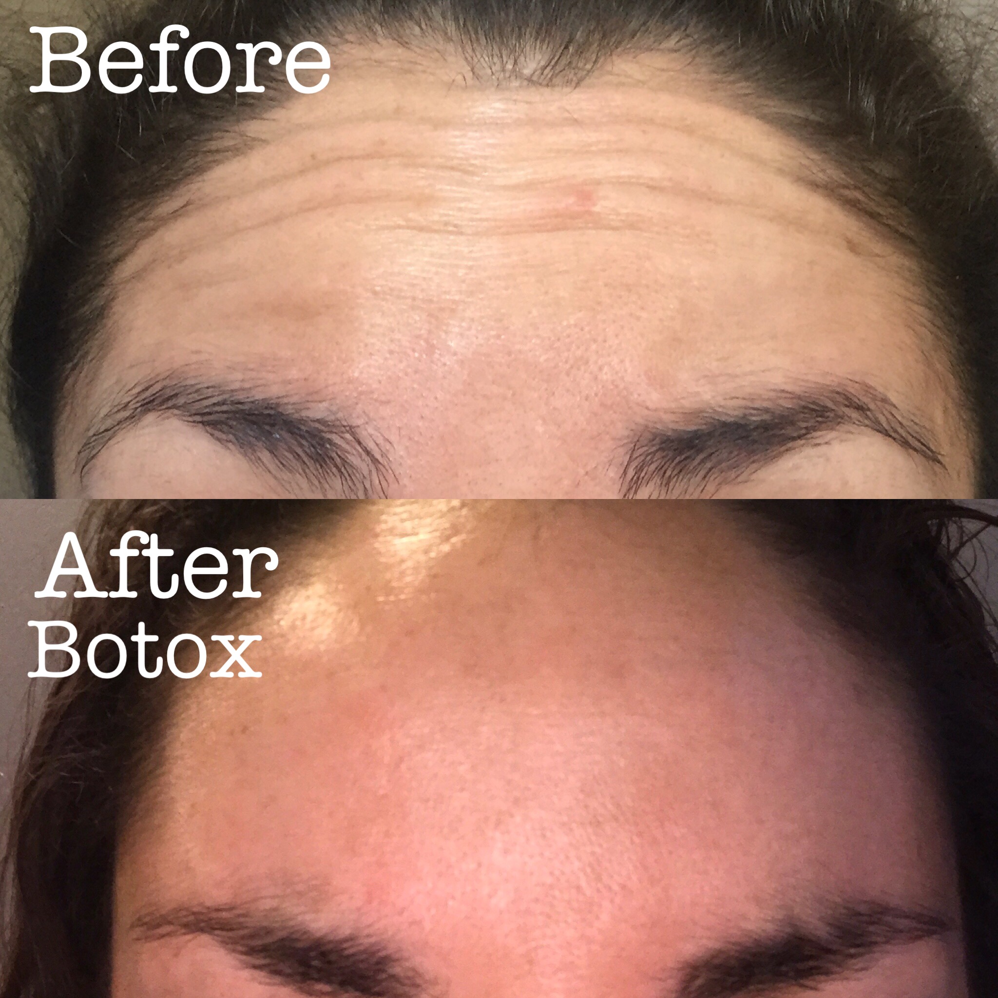 Botox!