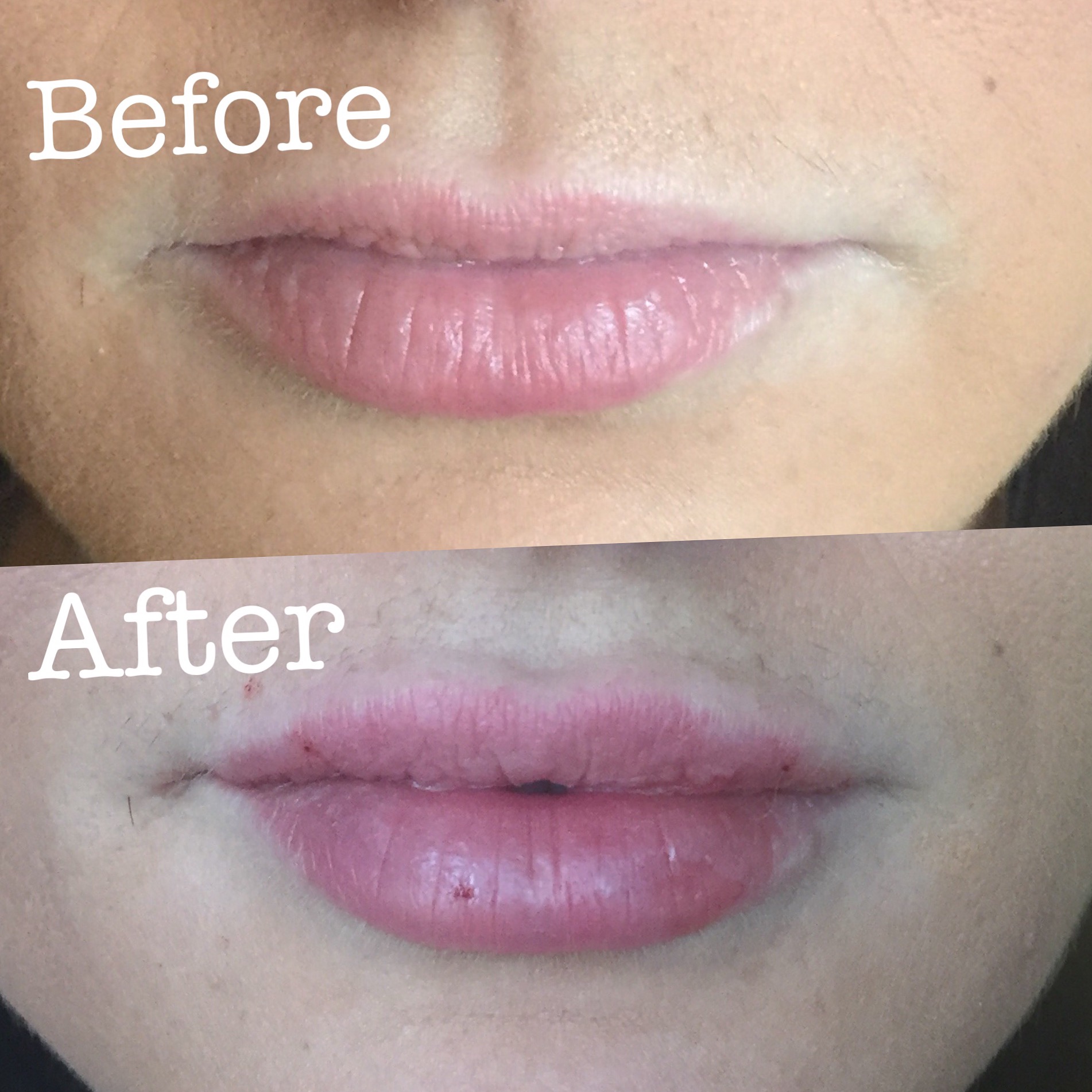 Before and after Lip Injections!