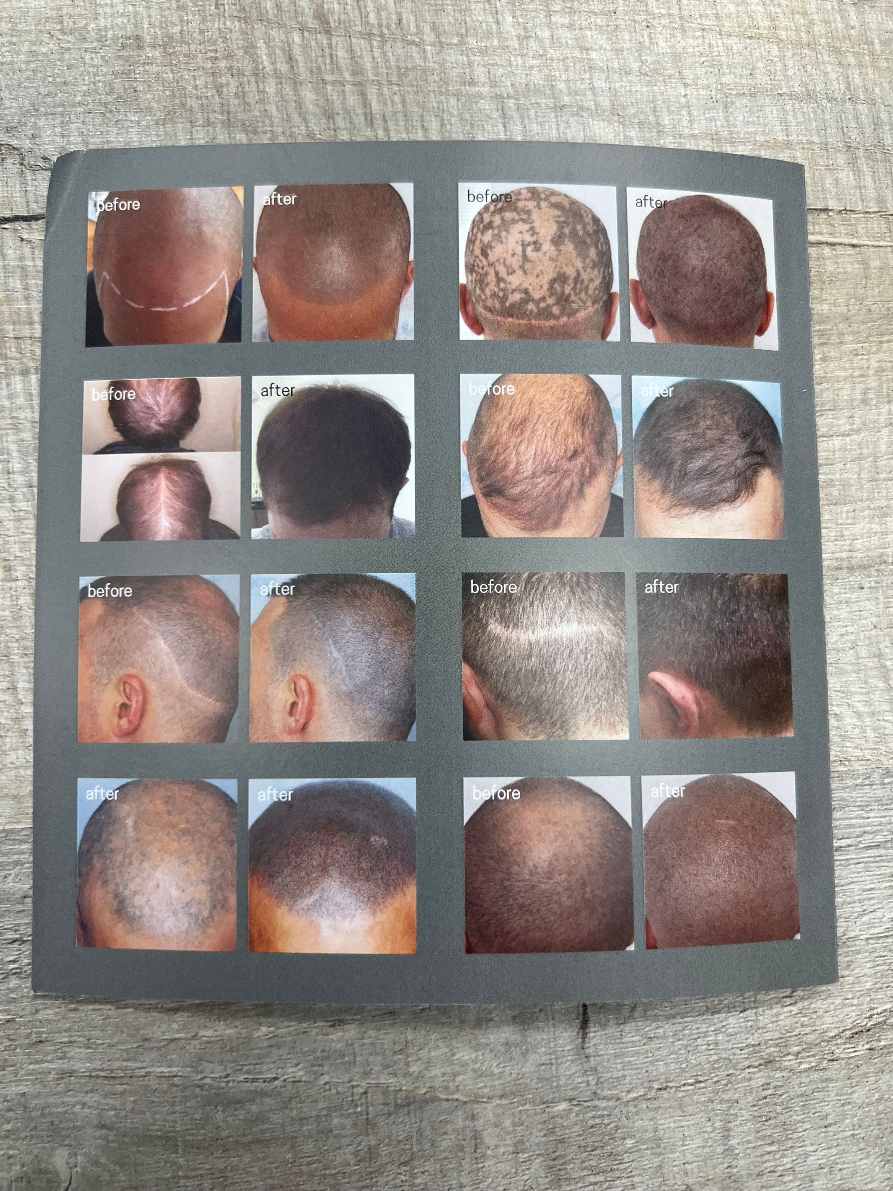scalp micropigmentation 2