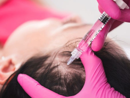 Are PRP Injections an Effective Solution for Hair Restoration?