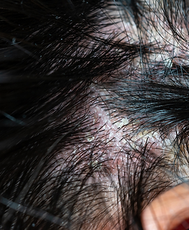 Residue on the Scalp.png