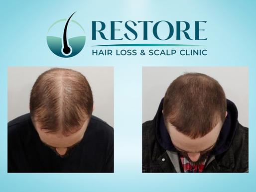Before and after image of a Restore Clinic client showing clear improvement in hair volume and scalp condition