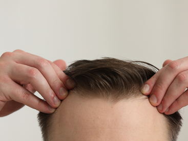 Is Your Hair Line Receding? Recognizing the Early Warning Signs of Balding