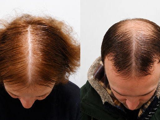 Hormonal Thinning: Why It Usually Starts Long Before You Notice It
