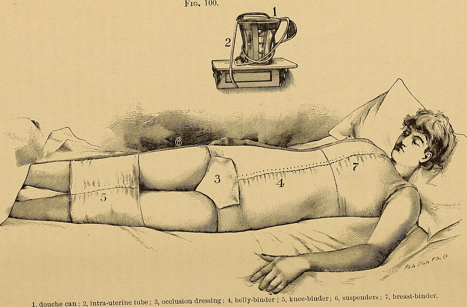Treatment of puerperal infection circa 1900. Before antibiotics, physicians relied on antiseptic irrigation, meticulous hand disinfection, and supportive care in an effort to control these often-fatal postpartum infections. Source: Barton Cooke Hirst, A System of Obstetrics (Philadelphia: Lea Brothers & Co., 1888). Yale University Cushing/Whitney Medical Library. Used under CC BY via Wikimedia Commons.