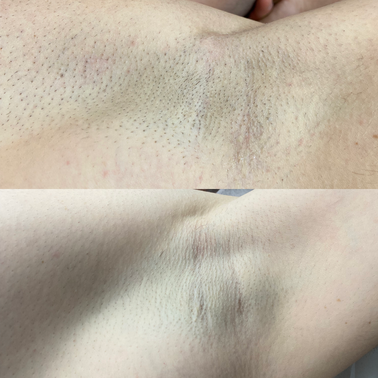 clinica cosmetica epilare cu laser in Suceava ofera si tratamente faciale precum peeling mezoterapie microneedling