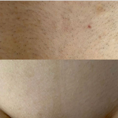 salon epilare definitiva suceava ofera tratamente curatare faciala si tratamente cosmetice hyaluron pen