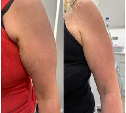 microneedling cu radiofrecventa fractionata atat pentru zona fetei cat si pentru corp cu rezultate garantate pentru piele laxa, vergeturi, cicatrici post-operatorii sau post-acneice. Lifting facial nechirurgical. Inductie profunda de colagen.