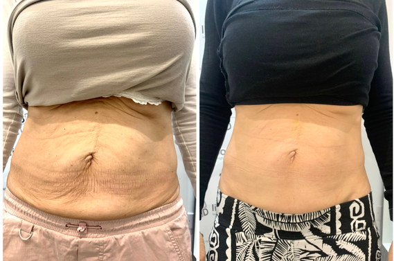 microneedling cu radiofrecventa fractionata atat pentru zona fetei cat si pentru corp cu rezultate garantate pentru piele laxa, vergeturi, cicatrici post-operatorii sau post-acneice. Lifting facial nechirurgical. Inductie profunda de colagen.