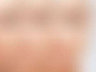 ¿Cómo combatir la Flacidez del Rostro?