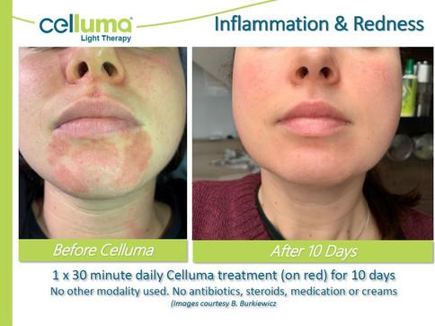 beforeafter-inflammationredness.jpeg