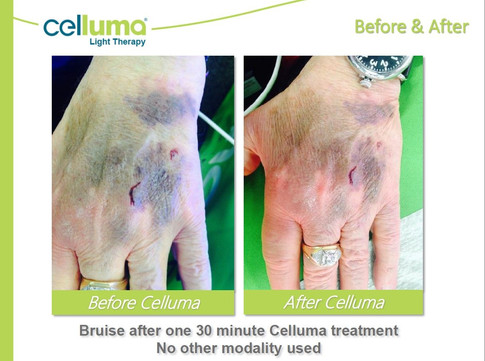 beforeafter-bruise1.jpeg