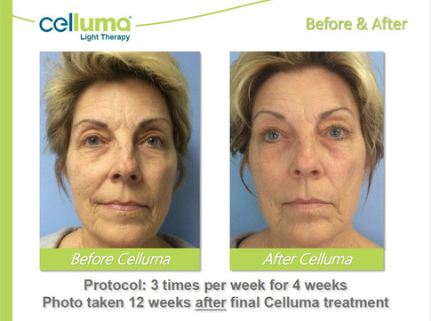 beforeafter-antiage.jpeg