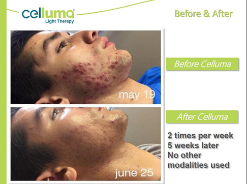 befoerafter-acne1.jpeg