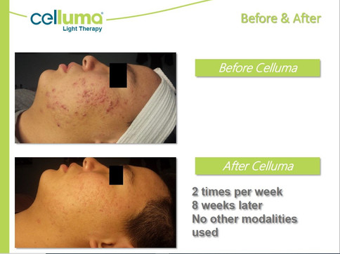 beforeafter-acne.jpeg