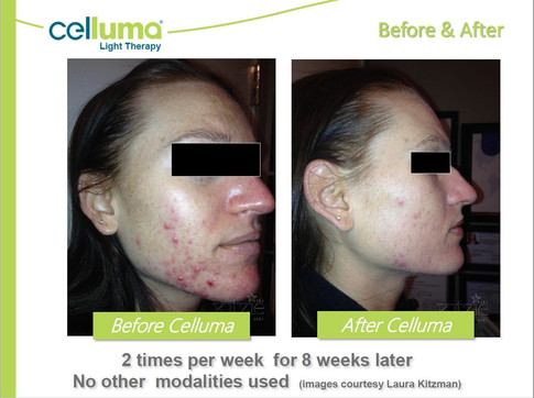 beforeafter-acne2.jpeg