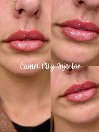 Lip Filler Winston-Salem