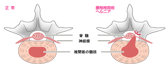 椎間板ヘルニア.gif