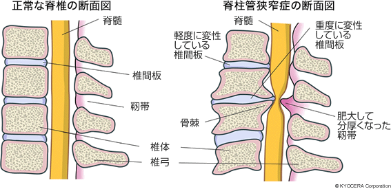 腰部脊柱管狭窄症.gif