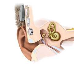 Bone-conduction-hearing-device