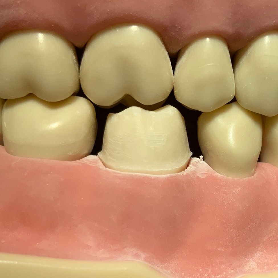 Full gold crown preparation