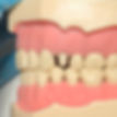 Metal ceramic crown preparation premolar