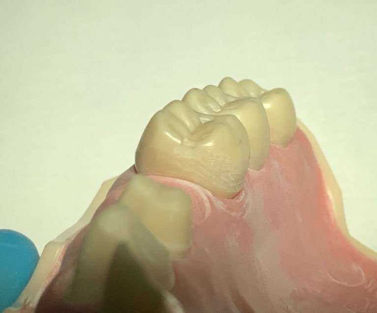 Resin retained bridge (resin bonded/adhesive bridge) posterior