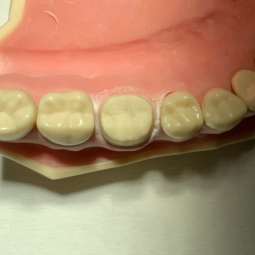 Full gold crown preparation