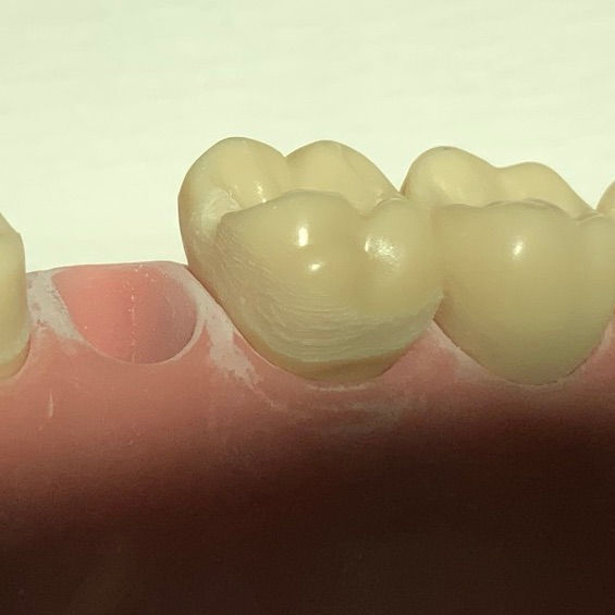 Resin retained bridge (resin bonded/adhesive bridge) posterior