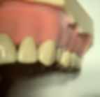Metal ceramic crown preparation premolar