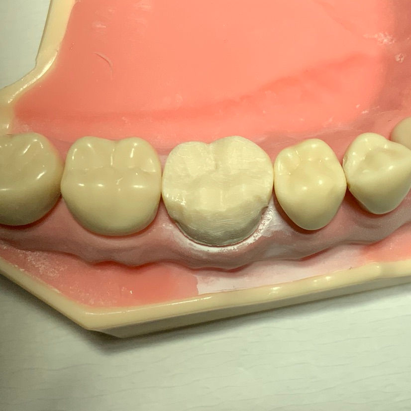 Full gold crown preparation