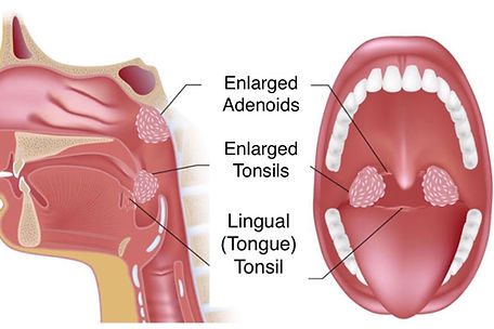 Obstructive Sleep Apnea Surgery.jpg