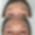 Smoother, Refreshed Forehead Appearance
