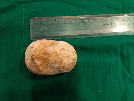 Prevent Kidney Stones: The Ultimate Guide to Do's and Don'ts for Optimal Kidney Health