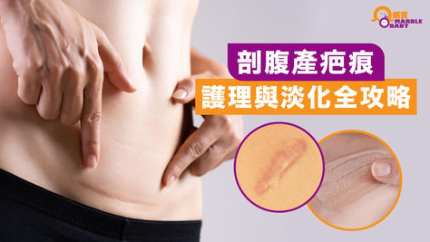 剖腹產疤痕護理與淡化全攻略