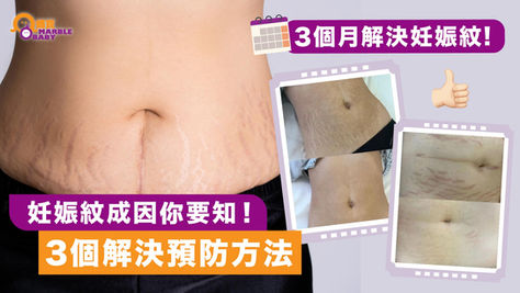 妊娠紋成因你要知!| 3個月解決妊娠紋 | 3個解決預防方法