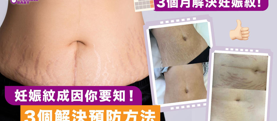 妊娠紋成因你要知！| 3個月解決妊娠紋 | 3個解決預防方法