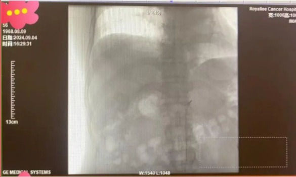 Diffuse Liver Cancer Treated with Yttrium-90 (Y90) in China