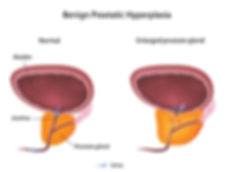 Benign Prostatic Hyperplasia
