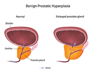 Benign Prostatic Hyperplasia